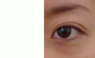 Non-incision Double eyelid surgery inThailand 