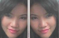 nose and eyelid surgery 5 days