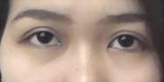 Double eyelid surgery non incision. After 1 week