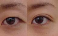 Non-incision Double eyelid surgery inThailand 
