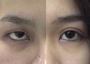 Double eyelid surgery, non incision