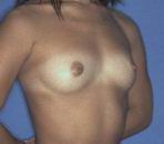 Breast Augmetation surgry Thailand before