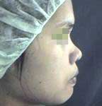 nose augmentation surgery before