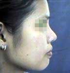 nose augmentation surgery immediate after