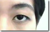 Double eyelid surgery non incision. Before