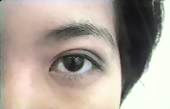 Double eyelid srgery non incision. After immediate