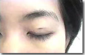 very small dimple, Double eyelid surgery non incision. After immediate