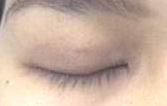 no visible scar, Double eyelid surgery non incision. after 1 week