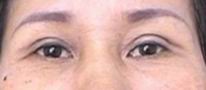 Upper eyelid surgery หลังแก้หนังตาตก 7 วัน
